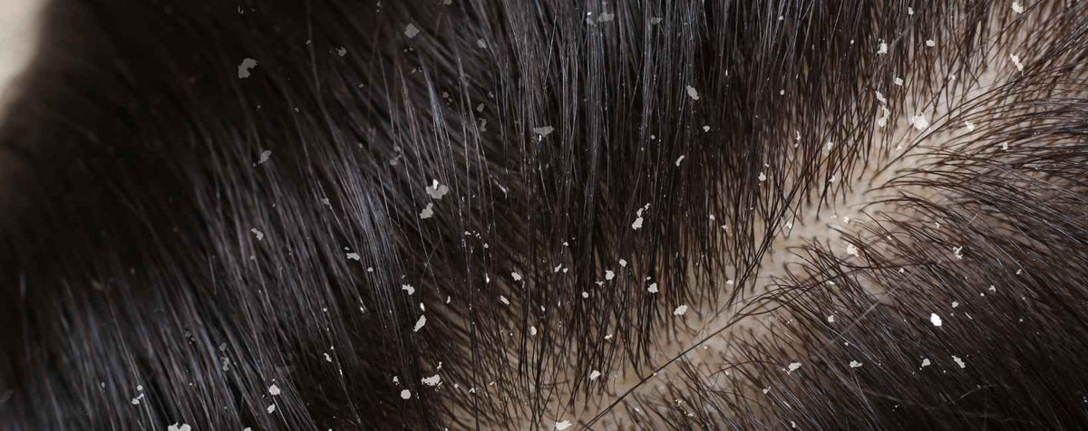Des cheveux avec pellicules