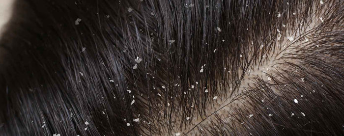 Des cheveux avec pellicules