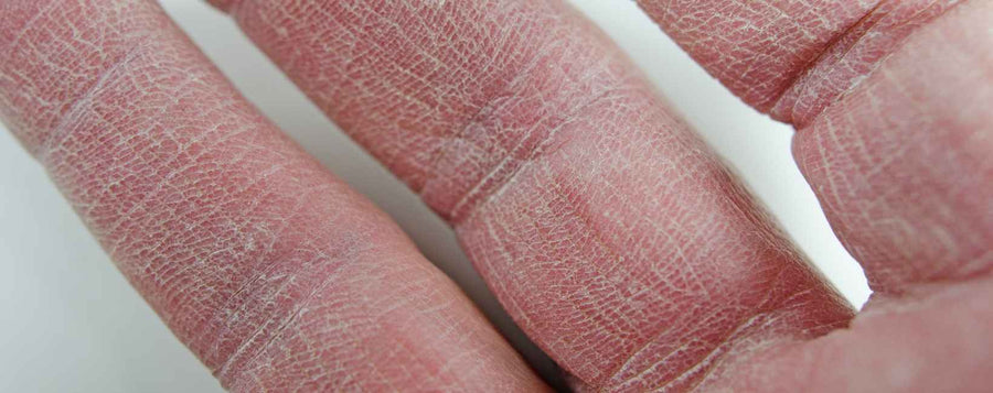 Mains gercées : causes et soins naturels pour retrouver des mains douces